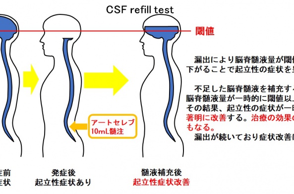 CSF%20refill%20test.jpg